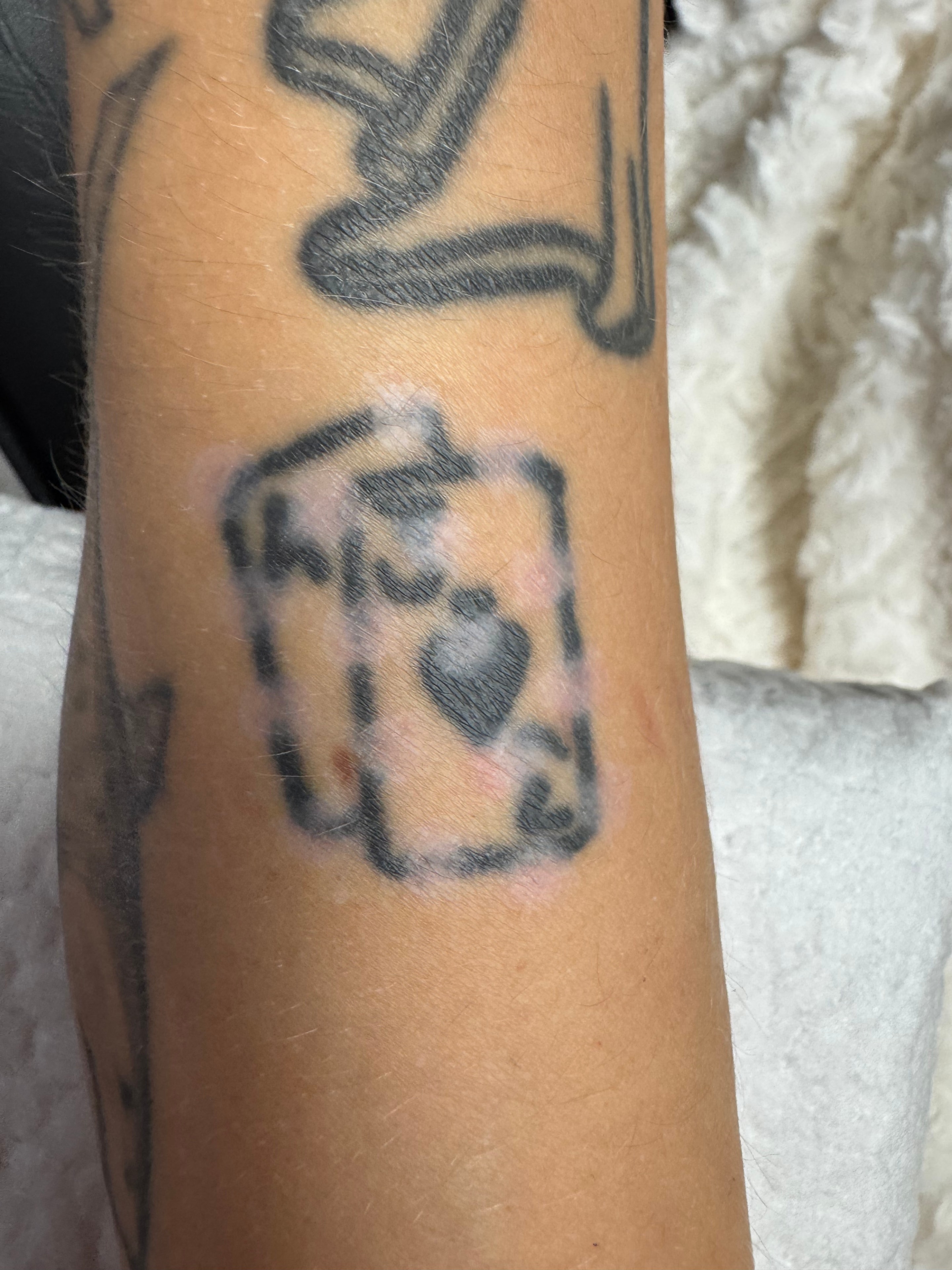Tattoo removal close-up — ink lifting from the skin.
